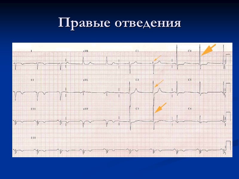 Правые отведения